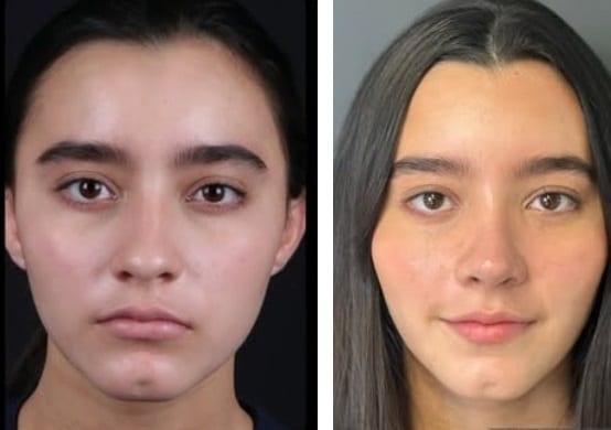 Rinoplastia caso 12 — antes y después